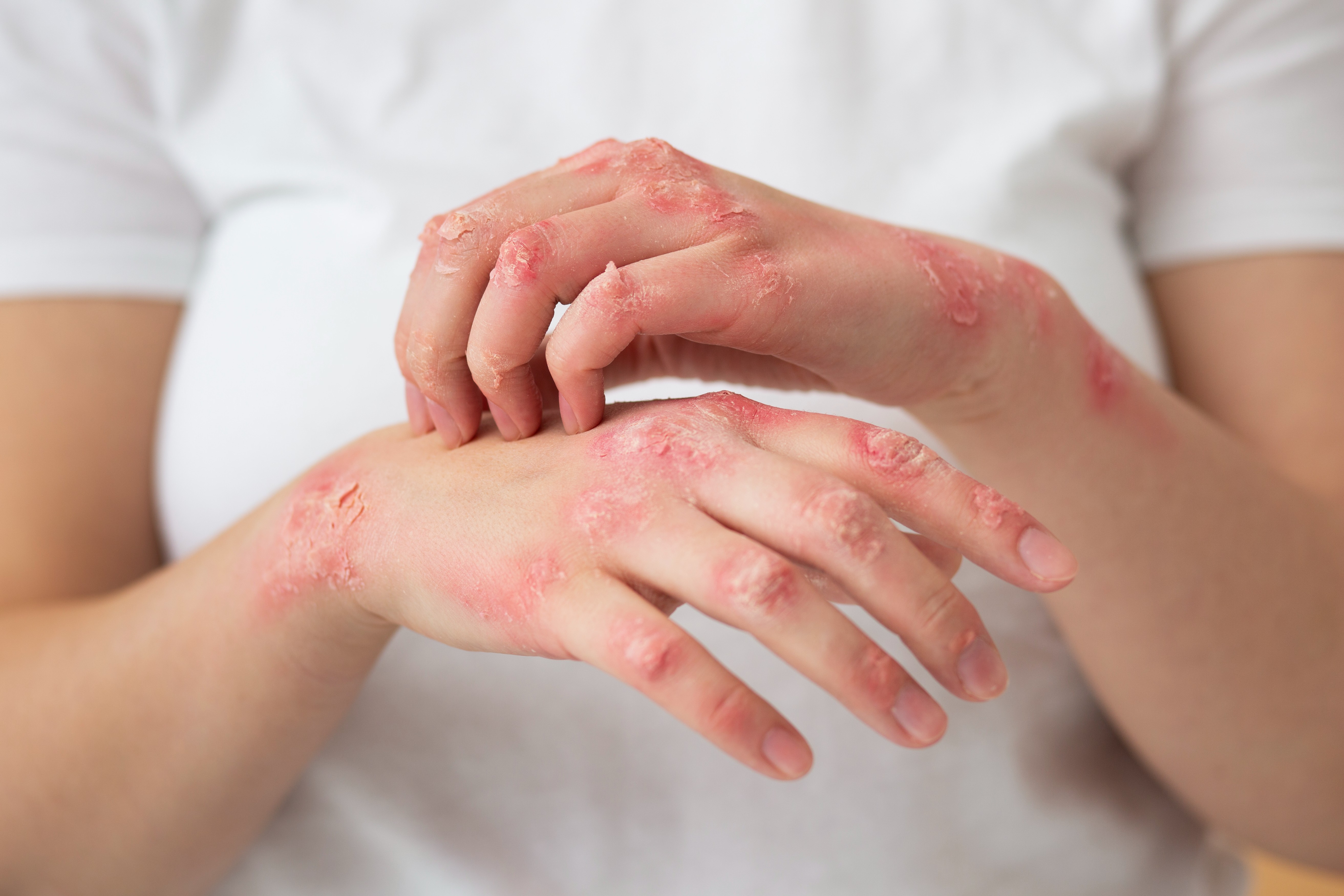 Skin Allergy